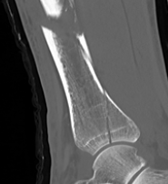 Posterior malleolus